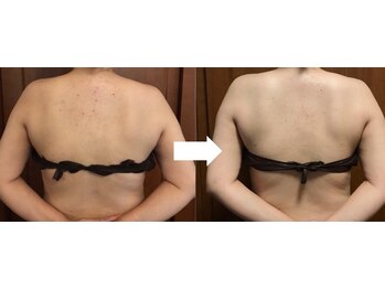 ヴァン ベール 那覇店/背中美肌ケア