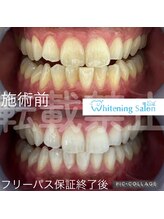 ホワイトニングサロン 名古屋 栄店/【ホワイトニング】
