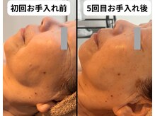 リベルタ/Wリフトフェイシャル