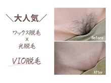 ルミエール(lumiere)/その日にツルツルVIOmix脱毛