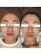 ウィルビー(will vi)の写真/長年蓄積された毛穴をすっきりさせながら　すべての悩み解消
最新韓国カーボキシーG－PEELでお悩み解消！