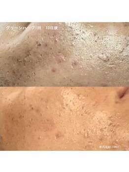 アネラ(ANELA)/エルモサハーブ症例.2