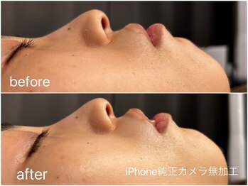 ブロートーキョー 有楽町店(BroTokyo)/角質も取れて透明感UP