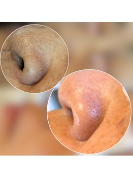 モモ(Momo.)/ハーブピーリング【毛穴ケア】