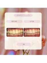 プラスビー 2号店(+b)/ホワイトニングビフォーアフター