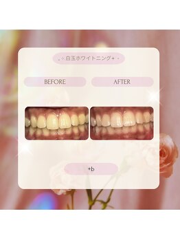 プラスビー 2号店(+b)/ホワイトニングビフォーアフター
