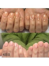 アネリー(ANERY.)/自爪育成・深爪育成