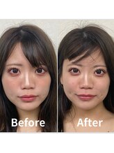 整体ラルース 中目黒(LALUZ)/20代 女性 頭蓋骨小顔矯正 変化