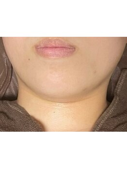 シミしわ改善！予防ケア