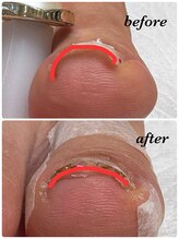 サンバイエム(#3/M)/【担当Yukino】巻き爪ケア♪