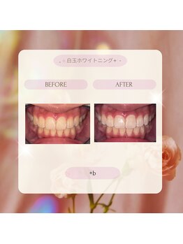 プラスビーセルフ(+b self)/ホワイトニングビフォーアフター