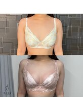 ジュリア(JULIA)/【バストアップ/育乳　症例】