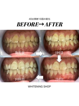 ホワイトニングショップ 茨木店/40分10回/ビフォーアフター