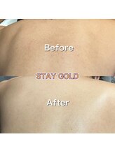 ステイゴールド 新百合ヶ丘(STAY GOLD)/自分で届かない、背中脱毛！！