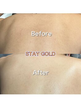 ステイゴールド 新百合ヶ丘(STAY GOLD)/自分で届かない、背中脱毛!!