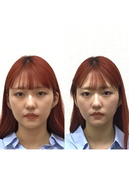 オズ六本木/六本木小顔矯正(造顔)施術1回