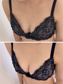 アンドモア(&more)/バストアップ症例