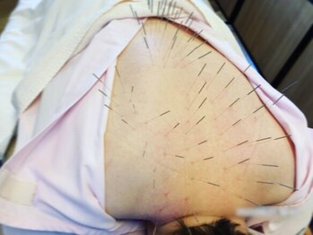 鍼灸かんなり治療院の写真/【普通の鍼ではもの足りないあなたへ】コリを芯から取り除く”ルート鍼”で首肩こり・腰痛を徹底改善◎