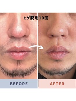 オフ(off)/ヒゲ脱毛