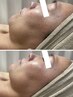 【エイジング悩みに効果抜群◎】くすみも撃退！光フェイシャル