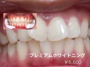 リモア(REMORE)/セルフでも驚かれる美白力