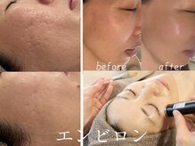 シュリー(Sriii)の雰囲気（シミくすみ改善/ハリツヤUP/毛穴改善/美肌に磨くエンビロン）