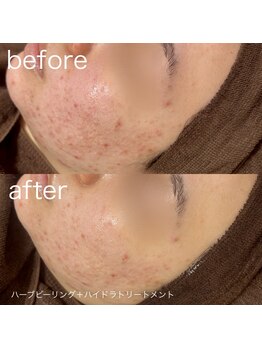 ルルラ リコ(lulula rico)/症例写真/ハーブピーリング