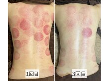 フリグス(Frigus)/【全身スライドカッピング】