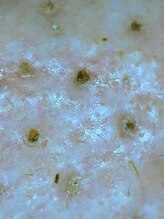 アイムエステ 表参道店(i'm este)/こりかたまった毛穴汚れ