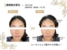 ただき接骨院 整体院 高崎本院/深層リフトケア美容鍼