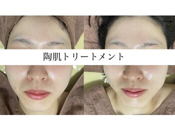 エッセンシャル 南海難波店(ESSENTIAL)/【REVI】ハーブピーリング