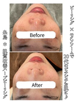 エヌプラス(N+)/30代女性*ピーリング1回後