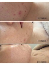 ルアナ(Luana)/ハーブピーリング