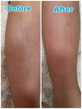 シュガーリングハウスレディ(SugaringHouse LADY)/キッズ脱毛