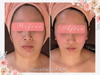 マリスステラ 天王寺(MarisStella)/驚きの小顔効果　天王寺/エステ