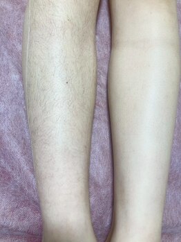 ビジュー(Bijou)の写真/≪速攻で効果実感！≫大満足の結果を感じていただける京都の老舗脱毛サロン！WAXと光のW脱毛も人気♪
