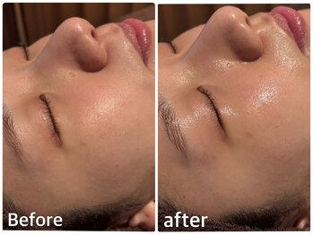 ボヌールデソワ(Bonheur de Soi)/ハーブピーリング