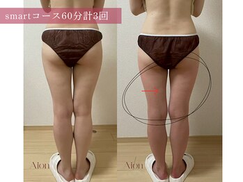 アイオン(Aion)/smartコース60分 計3回での変化