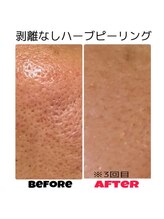 ココシア 取手店(COCOCIA)/ハーブピーリング症例★