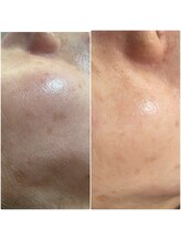 桜/最新光フェイシャル♪ビフォアフ