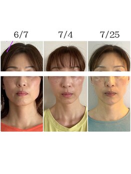 ミュアン(La Mueien)/小顔効果抜群！別人級！