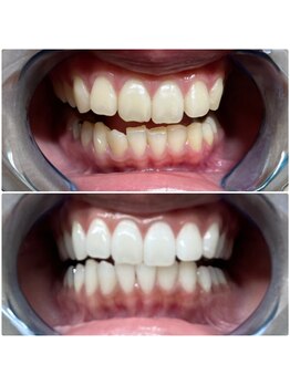 ライトケアサロン 表参道店(Light Care Salon)/セルフホワイトニング