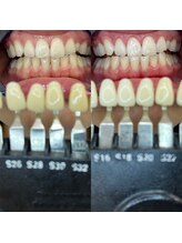 トウキョウスワーズ 池袋店(TOKYO SWRS)/#ホワイトニング #池袋 #渋谷