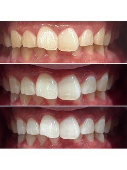 エピシアドットエヌ(epicia.N)/ホワイトニング30×3