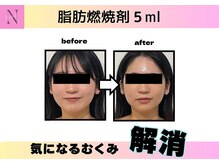 オーク ナチュリ 成城学園前(OAK×NACHUL)/【小顔】脂肪燃焼剤×最新高周波