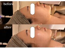 リスタ(RSTA)/【BEFORE/AFTER】