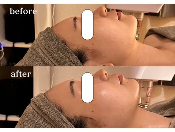 リスタ(RSTA)/【BEFORE/AFTER】