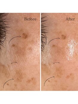 ラ レーヌ(La-leine)/シミケアエステ