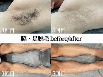 シャイン(SHINE)/脇・足脱毛ビフォーアフター