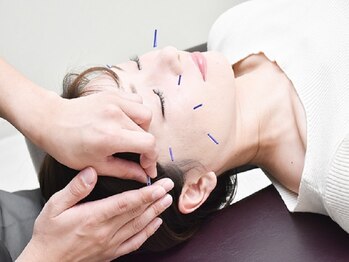 トータルトリートメント優鍼灸院の写真/憧れの小顔になりたい方必見！大人気【美容鍼×整体】全身トータルスタイルアップ美容矯正をお得に体験♪